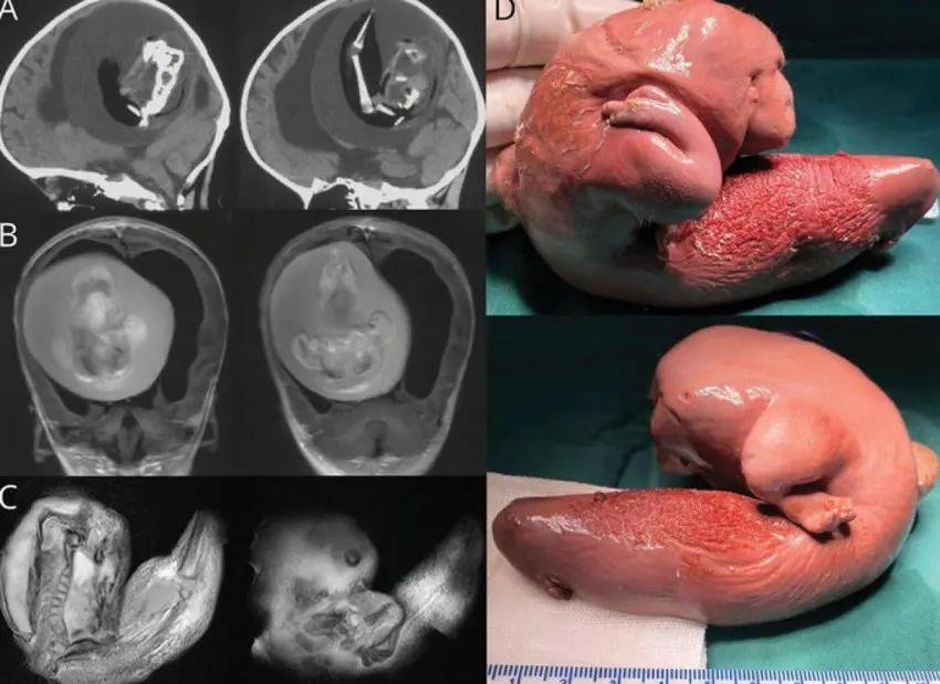 کۆرپەیەکی مردوو لە سەری منداڵێکی تەمەن 1 ساڵان دەهێندرێتە دەرەوە!