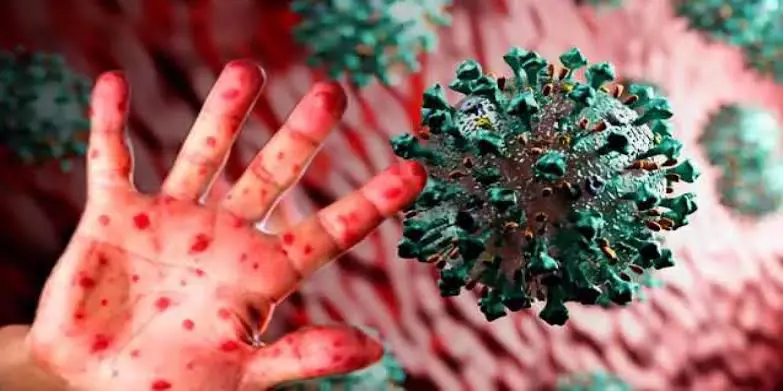 Maymun çiçegi Avrupa’ya siçradi: Isveç ilk vakayi duyurdu!