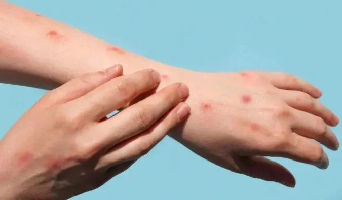 Vîrusa Çîçeka Meymûnî belav dibe: Vê vîrusê binasin