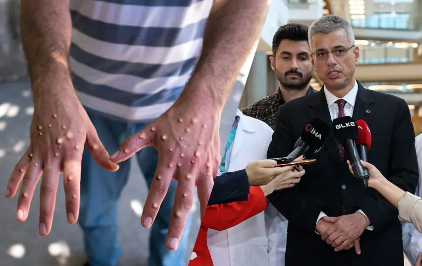 Türkiye’den ‘maymun çiçegi’ açiklamasi: Alarmdayiz!