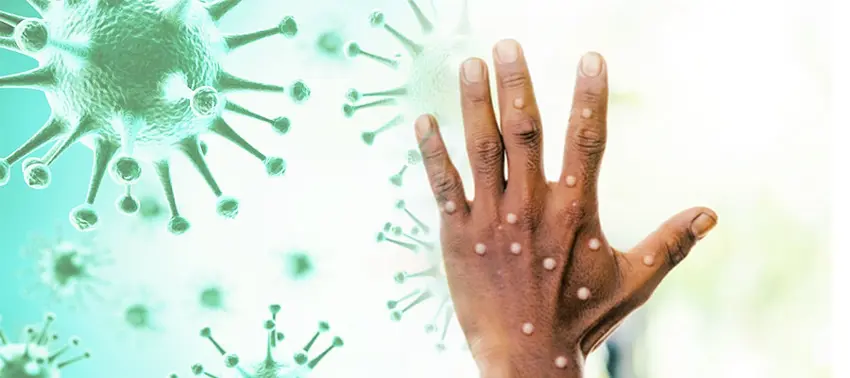 CDC: Maymun çiçegi kontrolden çikti!