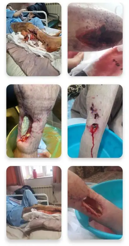 کۆڵبەرێكی بریندار لە دۆخی خراپی جەستەیی و پێویستی بە نەشتەرگەرییەكی خێرا هەیە