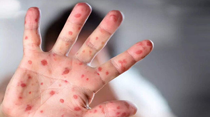 Li Tirkiyê 5 pêketiyên vîrusa MonkeyPox hatin tomarkirin