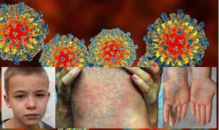 SORIK (Measles, Morbilli)