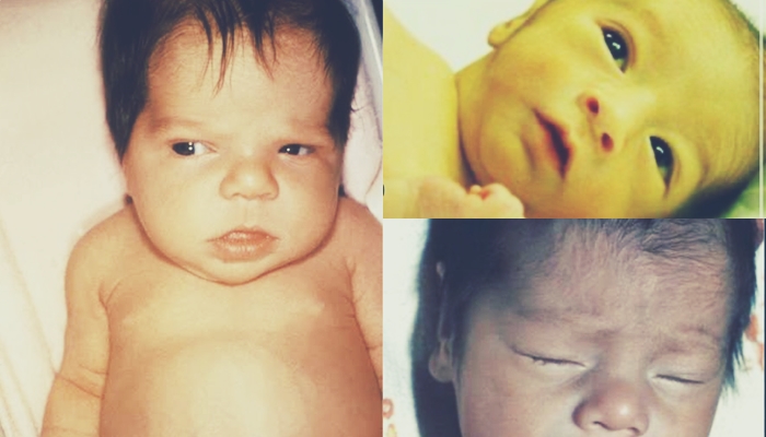 Hîpotîroîdîzma zikmakî (congenital hypothyroidism)