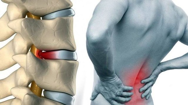 Bel agrisi bireyin yasam kalitesini azaltir