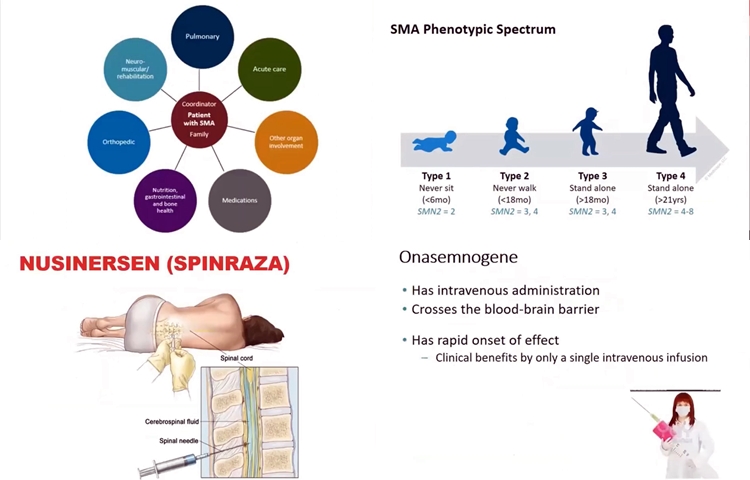 Nexwesiya AMD yan jî SMA