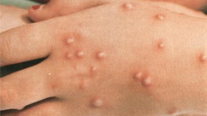 تەندروستیی جیهانی لەبارەی ئاوڵەی مەیموونەوە هۆشداری دەدات