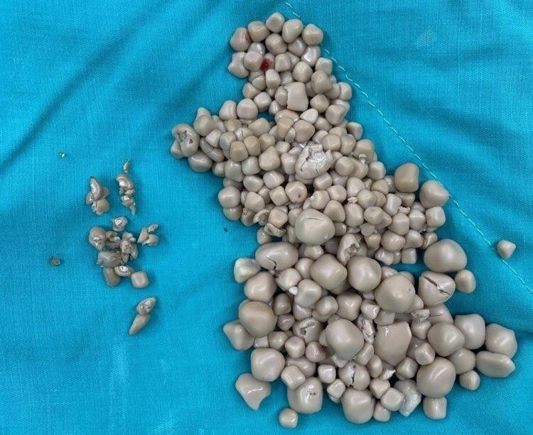 دۆزینەوەی کانزایەکی بەرد لە لاشەی ژنێکەوە !