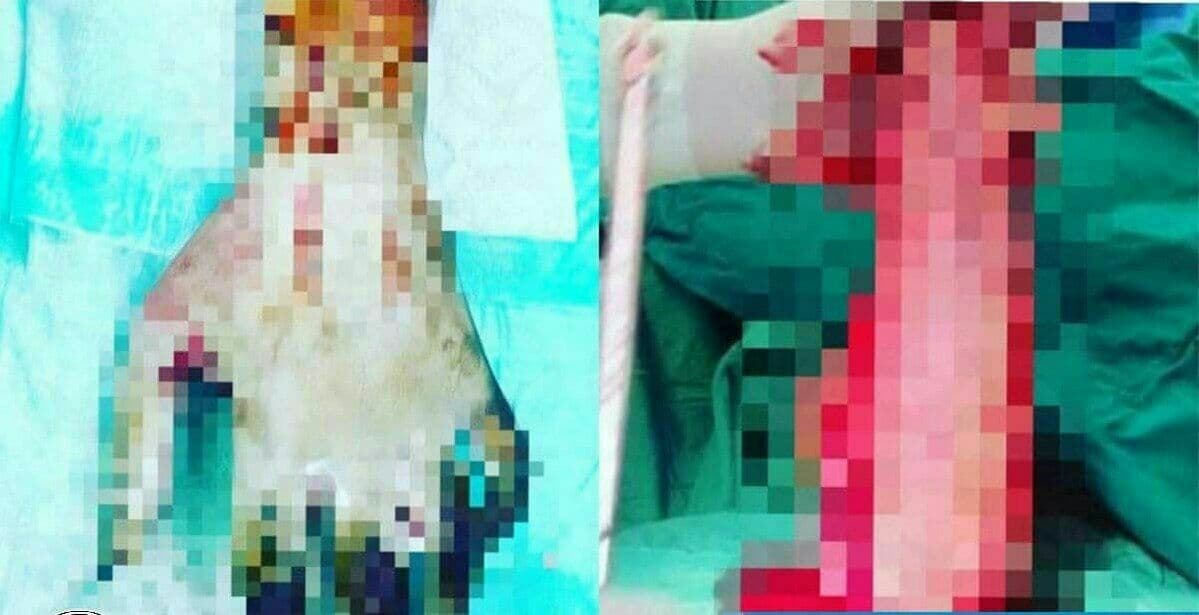 داوا دەکرێت ئەو پزیشکەی هەواڵی سووتانی کچەکەی لە لایەن باوکییەوە میدیایی کرد، سزا بدرێت