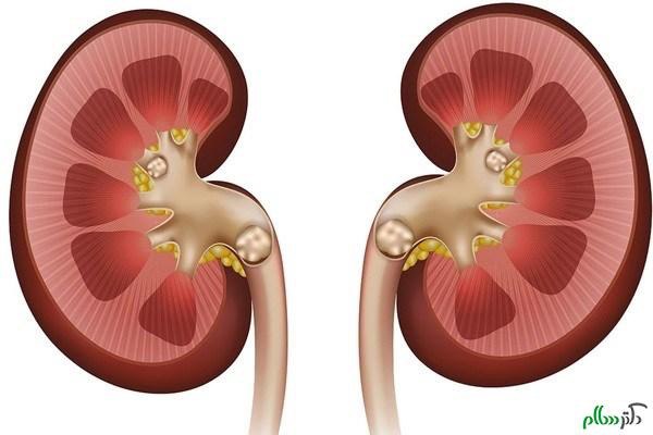 دوو هۆکاری سەرەکی بەردی گورچیلە