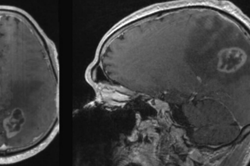 ڕێجیمێکی تایبەت کە هاندەری خۆکوشتنی خانەکانی شێرپەنجەی مێشکە