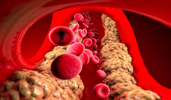 چارەسەری چەوری خوێن چییە ؟؟