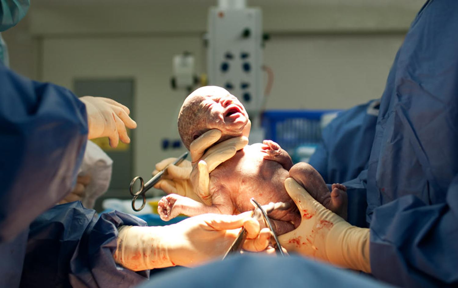 تەندروستیی جیهانیی: زۆربوونی ژمارەی نەشتەرگەریی منداڵبوون مەترسییەکی گەورەیە بۆ سەر تەندروستیی کۆرپەکان